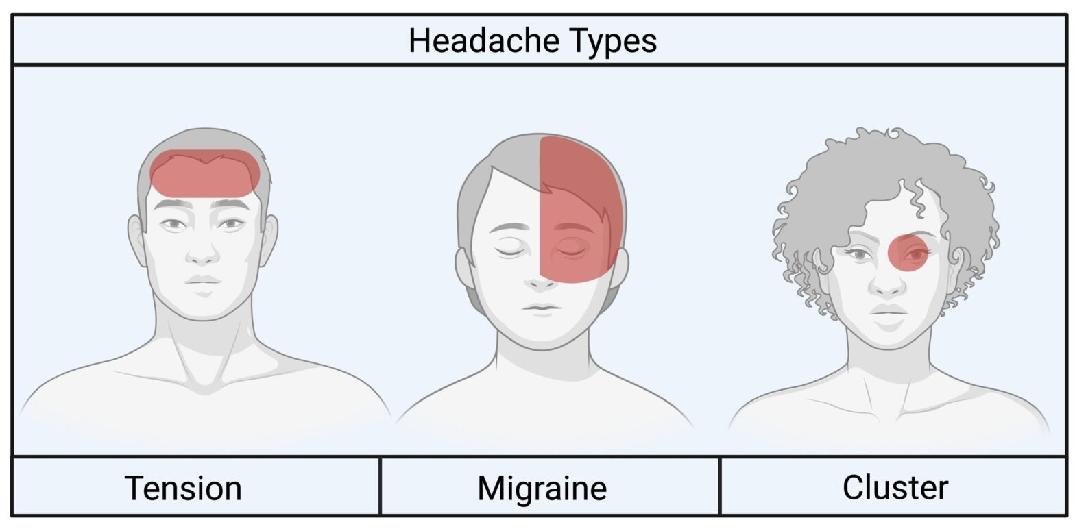 International Headache Classification -3